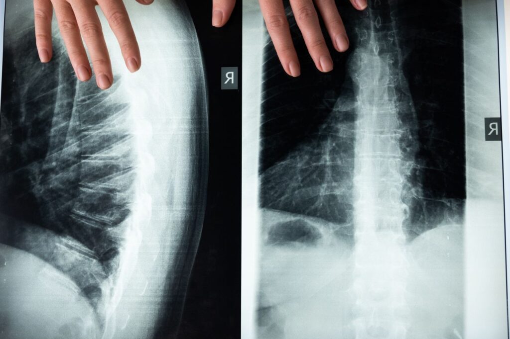 pexels photo 5723876 An illustrative close-up of a spine X-ray with hands, highlighting medical imaging and anatomy.